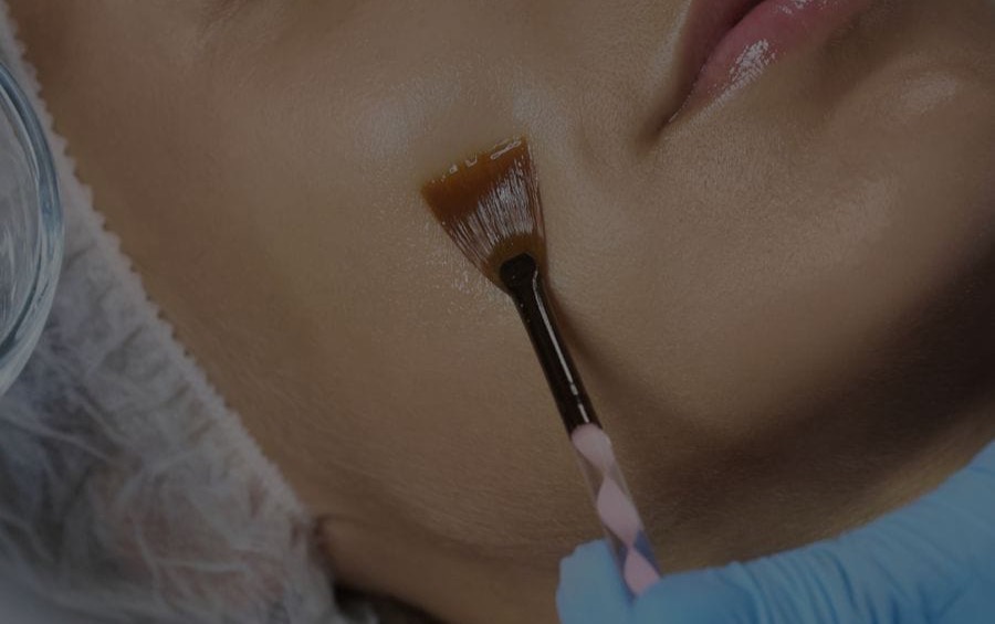 Peeling químico en Siempre Bella
